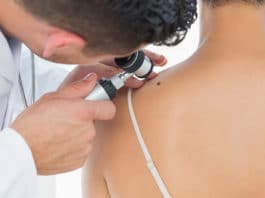 Al via prevenzione gratuita melanomi della pelle. Come prenotare la visita ad Anzio e Nettuno