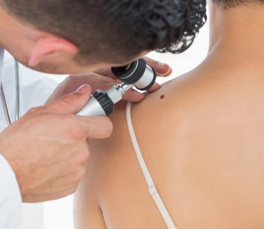 Al via prevenzione gratuita melanomi della pelle. Come prenotare la visita ad Anzio e Nettuno