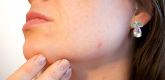Cause e rimedi per chi soffre di acne